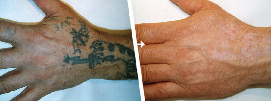 Nach 1 Jahr Finger Tattoo Vorher Nachher tattooentfernung-essen.de